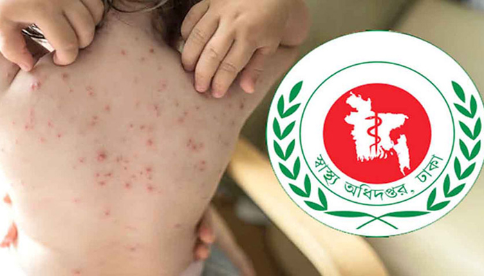 হাম ও হামের উপসর্গ নিয়ে দেশে আরও ১১ শিশুর মৃত্যু