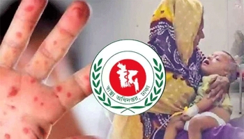 হাম ও হামের উপসর্গ নিয়ে আরও ৯ শিশুর মৃত্যু